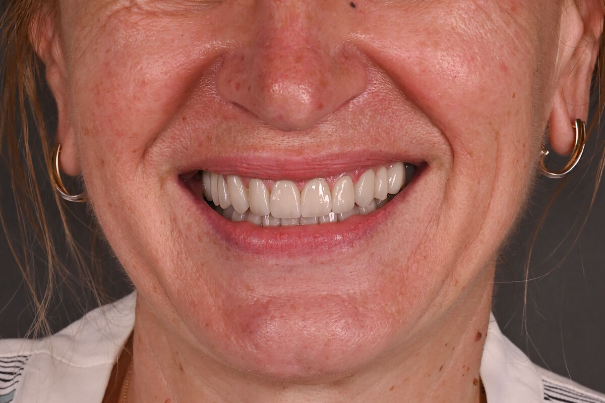 Zâmbet lateral stanga_dupa